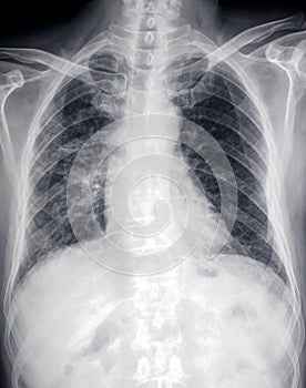 Lung diseaseï¼šfront X-ray image of heart and ches