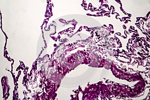 Lung emphysema, light micrograph