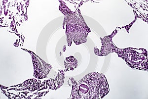 Lung emphysema, light micrograph