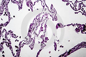 Lung emphysema, light micrograph