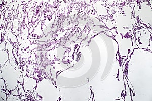 Lung emphysema, light micrograph