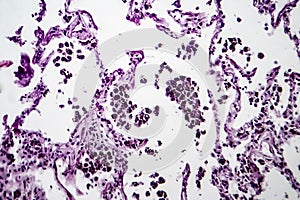 Lung emphysema, light micrograph