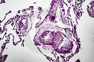 Lung emphysema, light micrograph