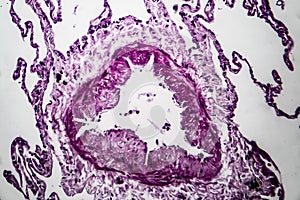 Lung emphysema, light micrograph