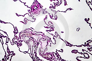 Lung emphysema, light micrograph