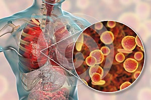 Lung infection caused by bacteria Mycoplasma pneumoniae