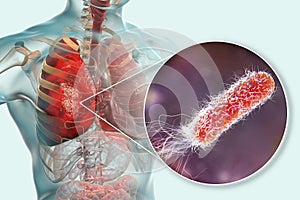 Lung infection caused by bacteria Pseudomonas aeruginosa