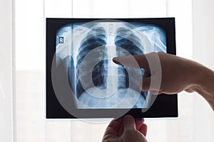 Lung radiography concept. Radiology doctor examining at chest x ray film of patient Lung Cancer or Pneumonia. Virus and