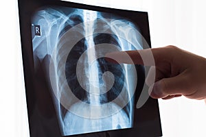 Lung radiography concept. Radiology doctor examining at chest x ray film of patient Lung Cancer or Pneumonia. Virus and