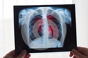 Lung radiography concept. Radiology doctor examining at chest x ray film of patient Lung Cancer or Pneumonia. Virus and