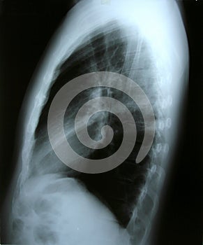 Lung x-ray