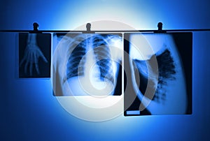 Lung X-ray negatives