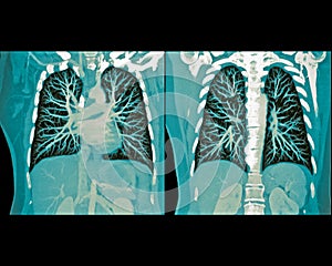 Lung scan