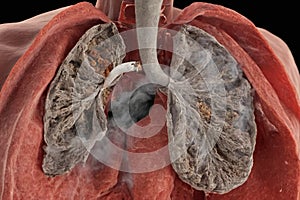 Lung and smoke bad habit and lung cancer issue