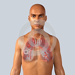 Lung tuberculosis, 3D illustration