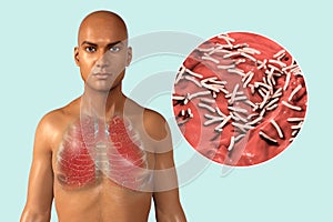 Lung tuberculosis, 3D illustration