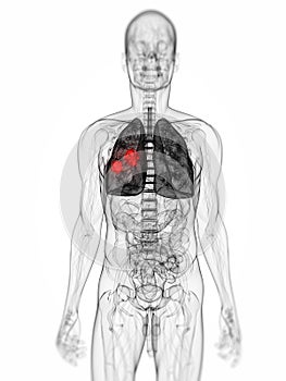 Lung tumor