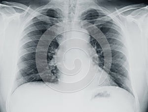 Lung Xray img