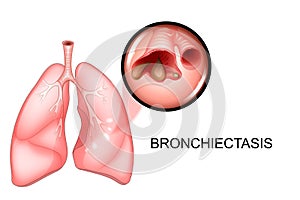 Lungs affected by bronchiectasis disease