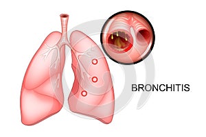 The lungs, affected with bronchitis