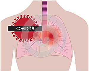 Lungs affected with coronavirus infection COVID19