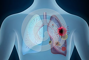 Lungs affected by a COVID-19 vector illustration