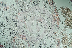 Lungs with amyloid deposits of sick tissue