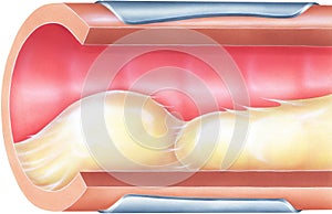 Lungs - Bronchial Mucus Causing Airway Obstruction