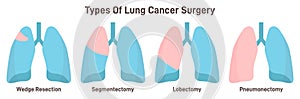 Pulmones cáncer cirugía tipos. cli 