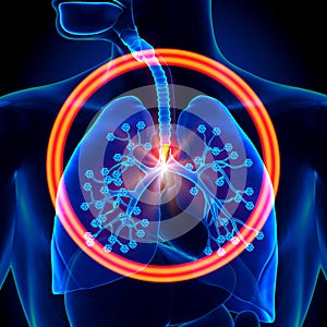 Lungs Foreign Object - inhaled or swallowed