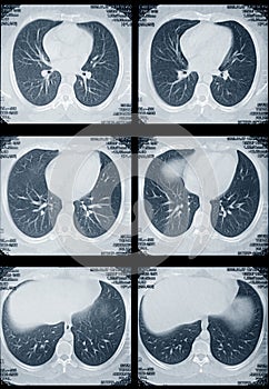 Polmoni un cuore tomografia 