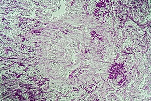 lungs Infection with Candida and Aspergillus photo