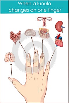 When a lunula changes on one finger