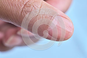 Lunula and longitudinal ridging nail on thumb ( vertical nail ridges). photo