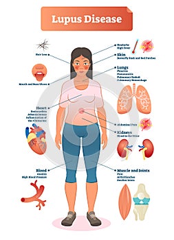 Lupus disease vector illustration. Labeled diagram with sickness symptoms.
