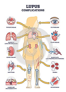 Lupus erythematosus medical autoimmune disease complications outline diagram