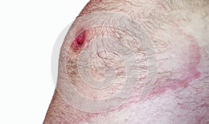 Lyme borreliosis - erythema migrans photo