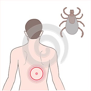 Lyme disease, Borreliosis or Borrelia