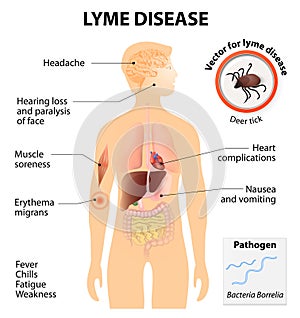 Lyme disease or Lyme borreliosis