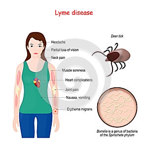 Lyme disease. Woman with erythema, signs and symptoms Lyme borreliosis. photo