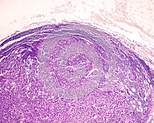 Lymph node. Carcinoma metastasis