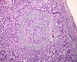 Lymph node. Carcinoma metastasis