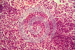 Lymph node cells under the microscope.