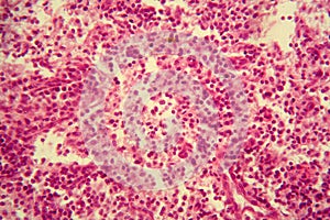 Lymph node cells under the microscope.