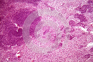 Lymph node cells under the microscope.