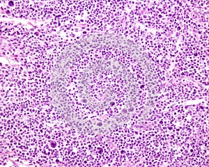 Lymph node. Hodgkin lymphoma photo