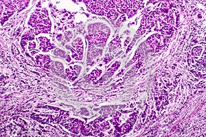 Lymph node metastasis