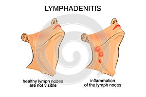 Lymphadenitis . inflammation of the lymph nodes photo