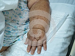 Lymphatic edema in a elderly female due to axillary emptying for breast cancer