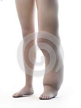 a lymphedema